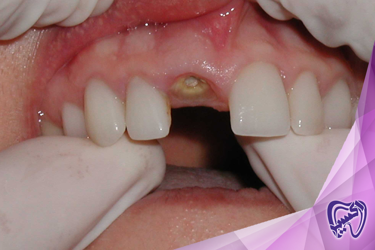  انواع شکستگی دندان
