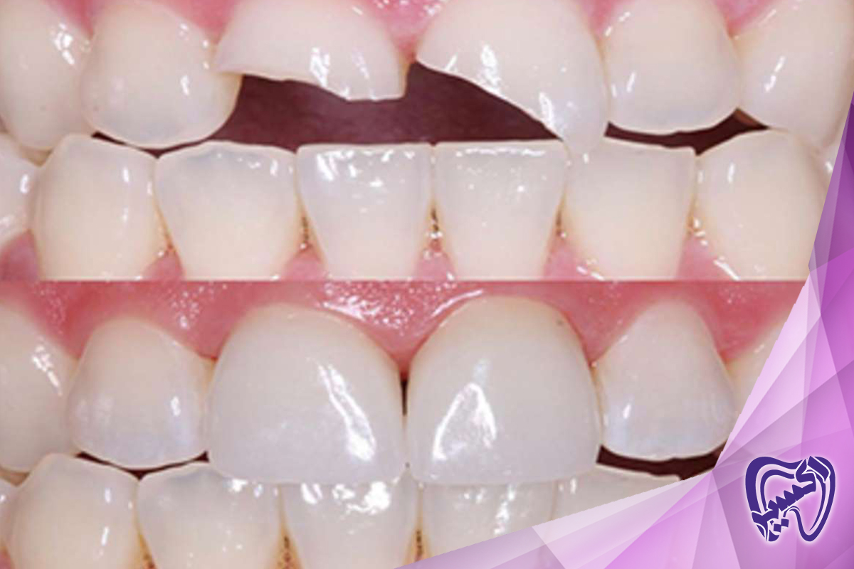 گزینه های درمان شکستگی دندان