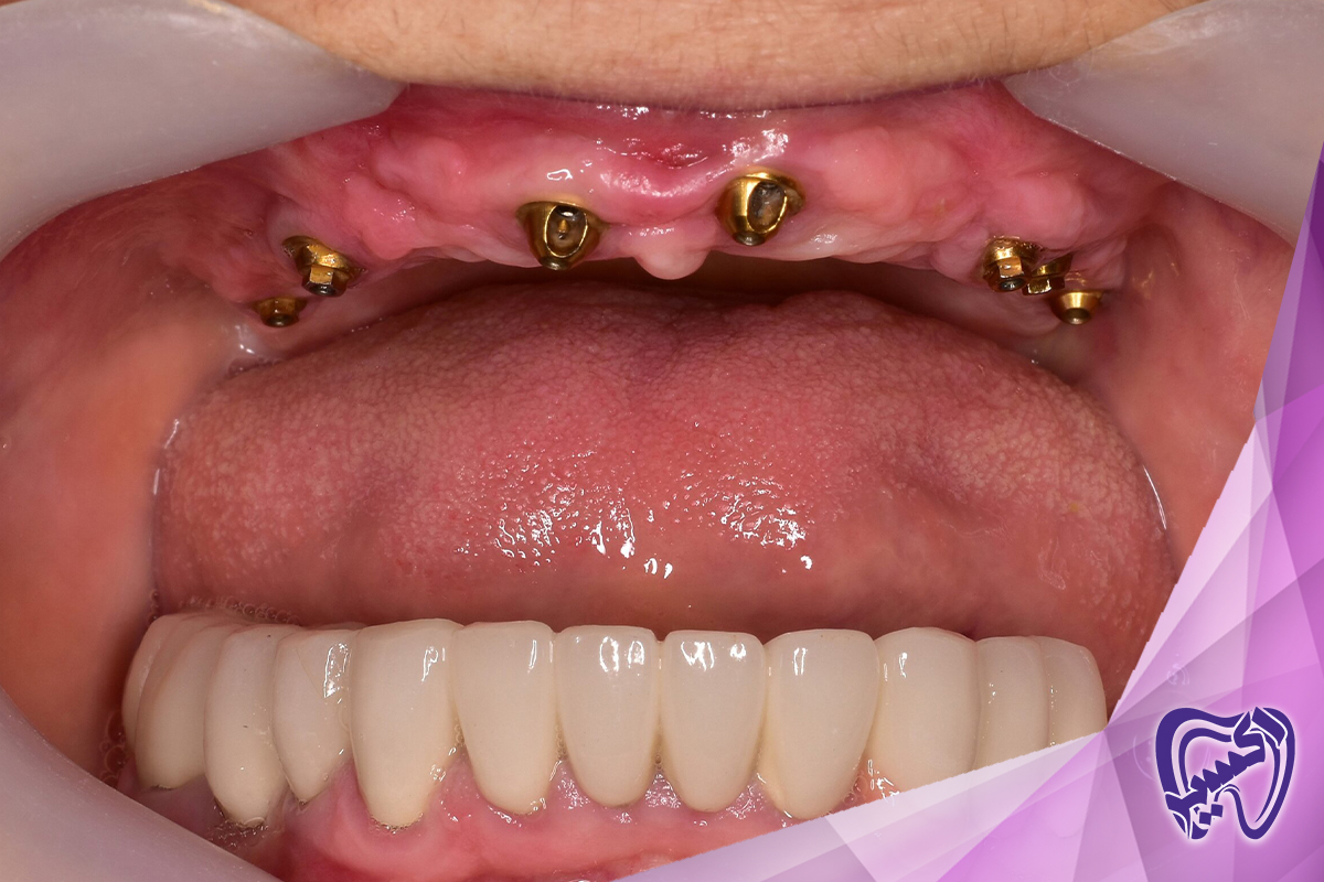 اهمیت انتخاب متخصص ایمپلنت دندان مناسب