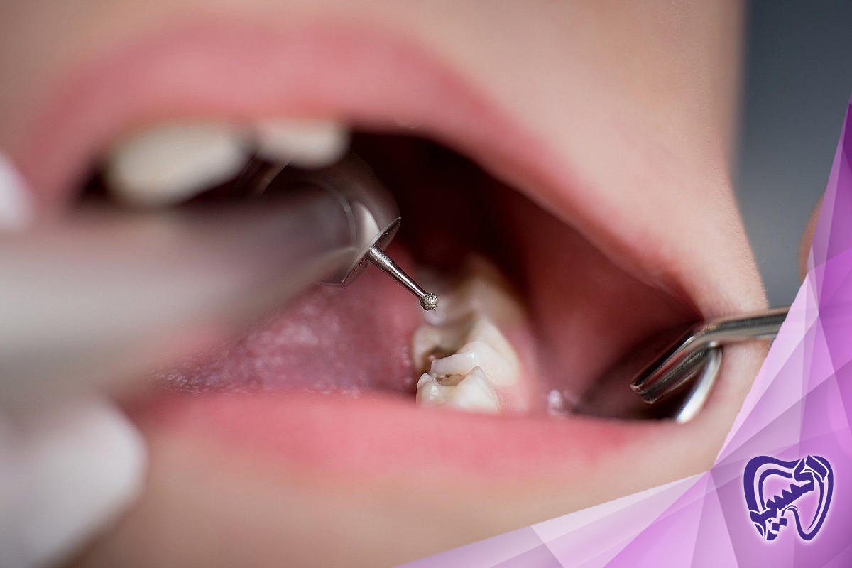 تکنیک‌های ترمیم دندان برای کودکان