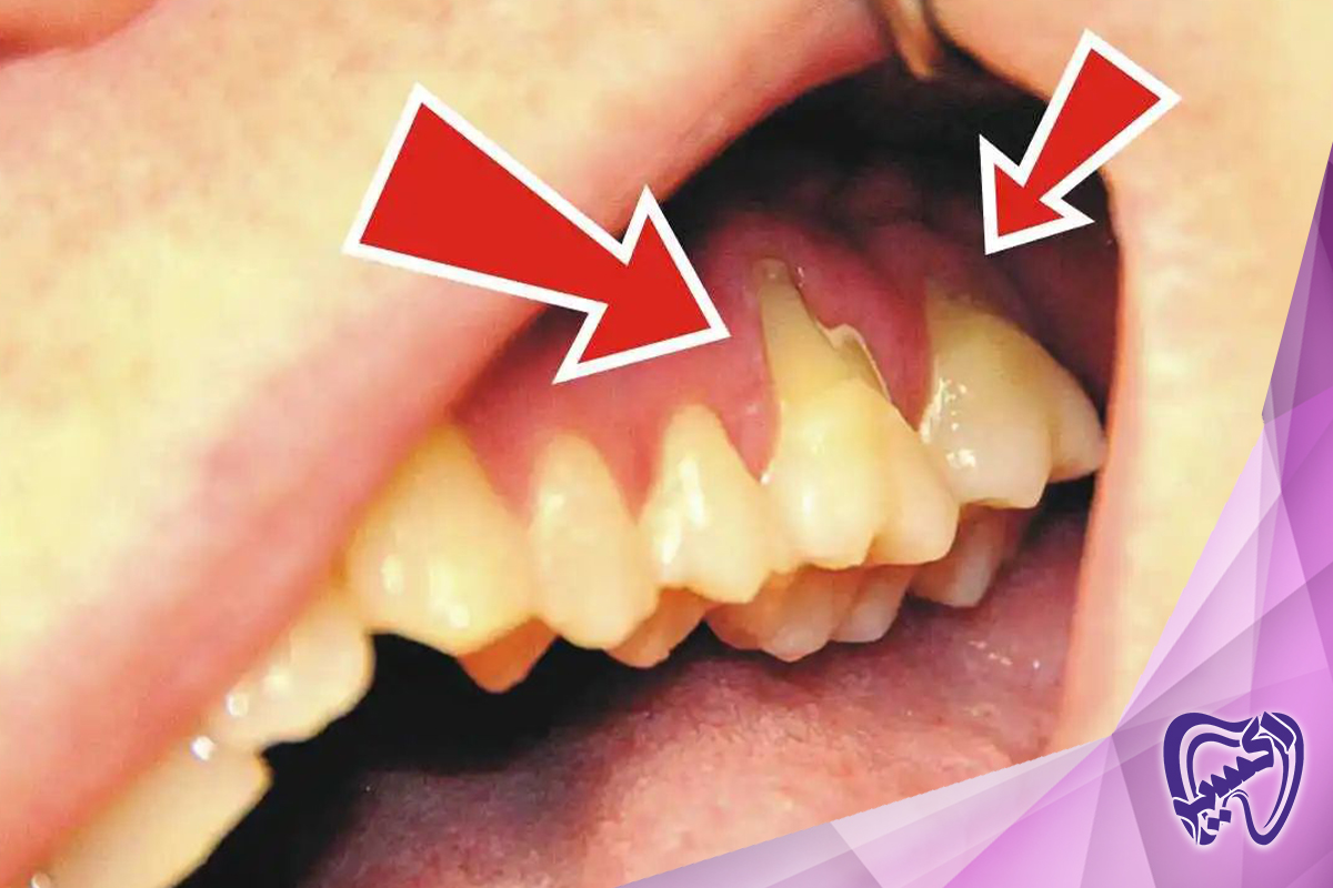 محرک‌های رایج برای حساسیت دندان