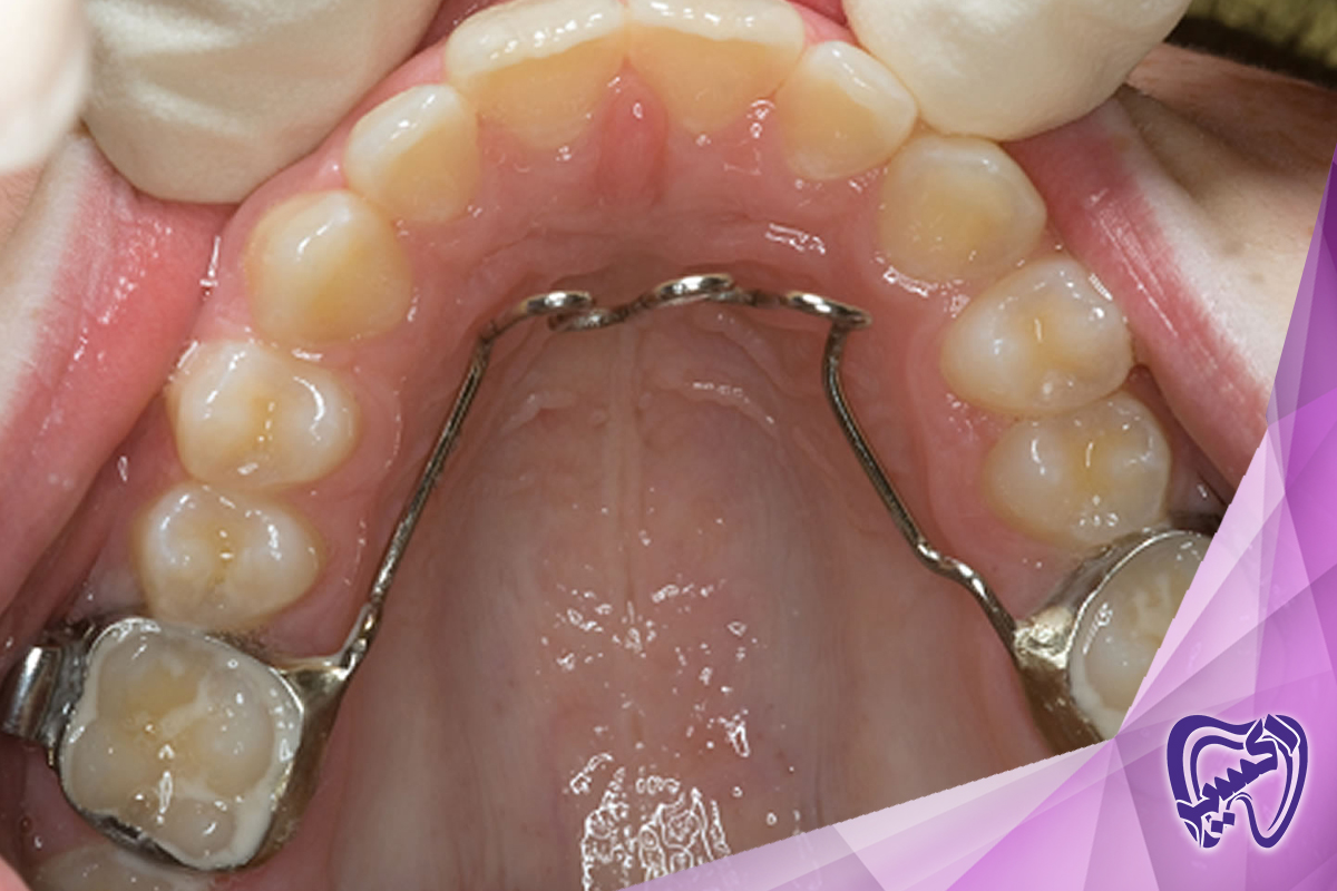 استفاده از پستانک و اثرات منفی آن در سلامت دهان و دندان کودکان