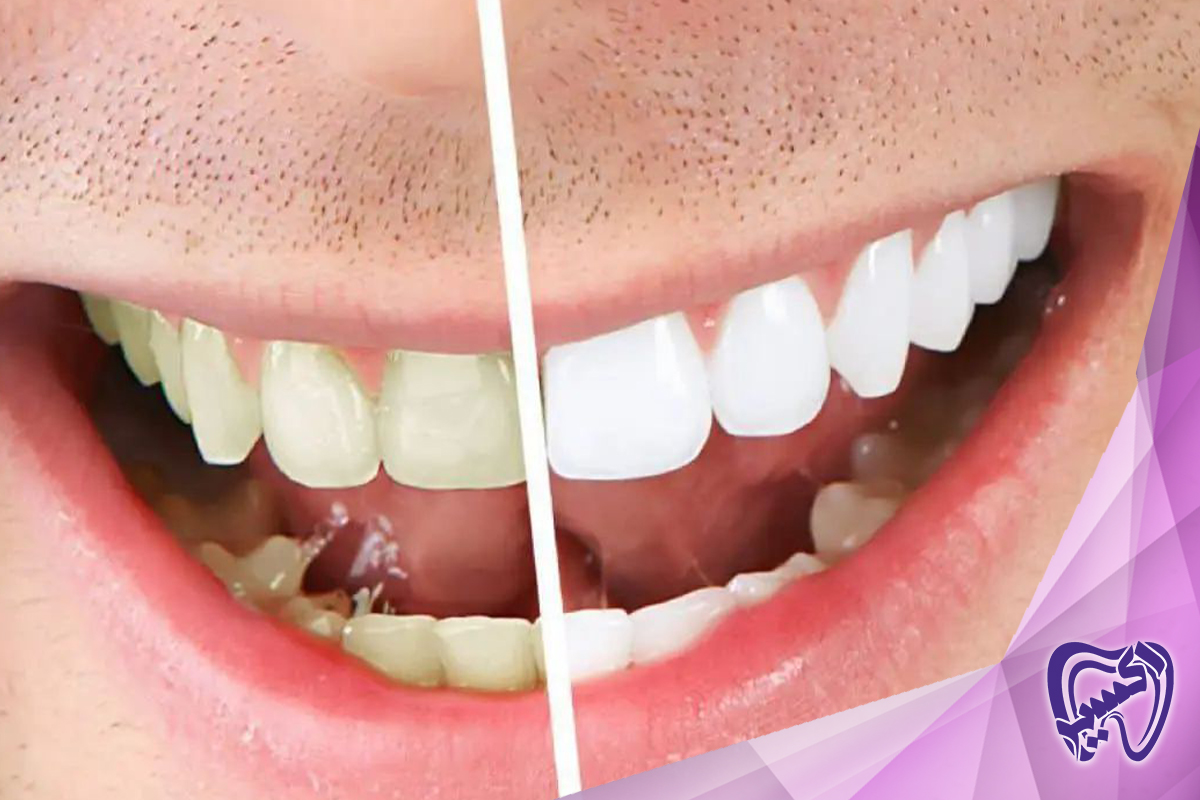 سفید کردن دندان و حساسیت دندان