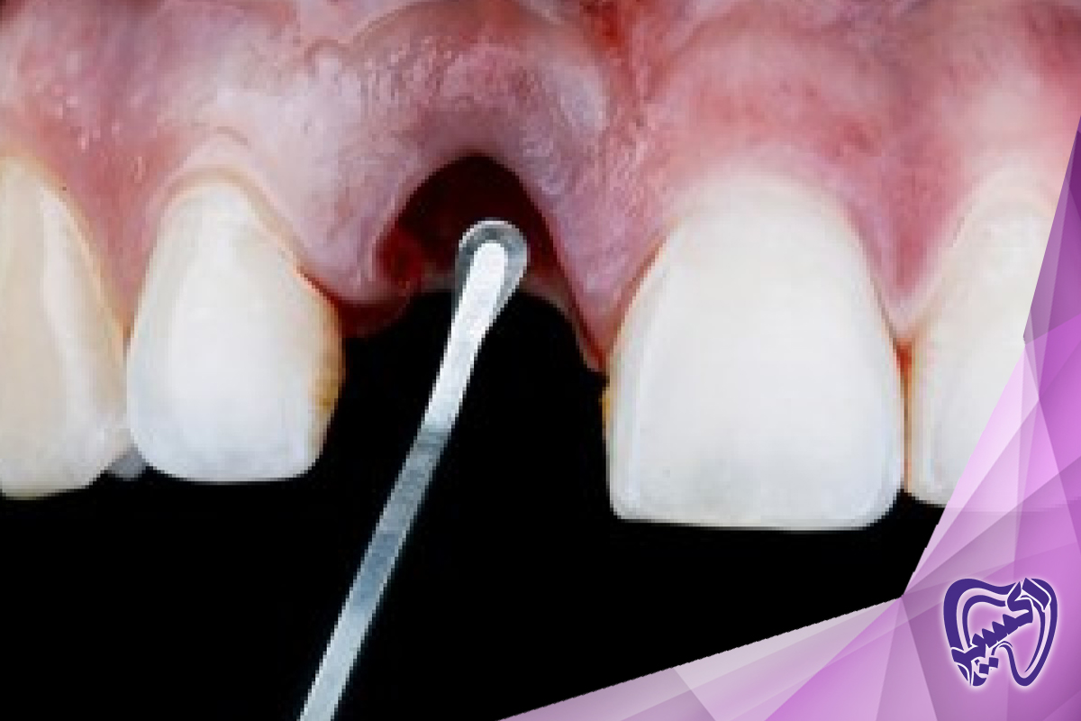 آیا می توان جراحی لثه را با سایر روش های دندانپزشکی ترکیب کرد؟