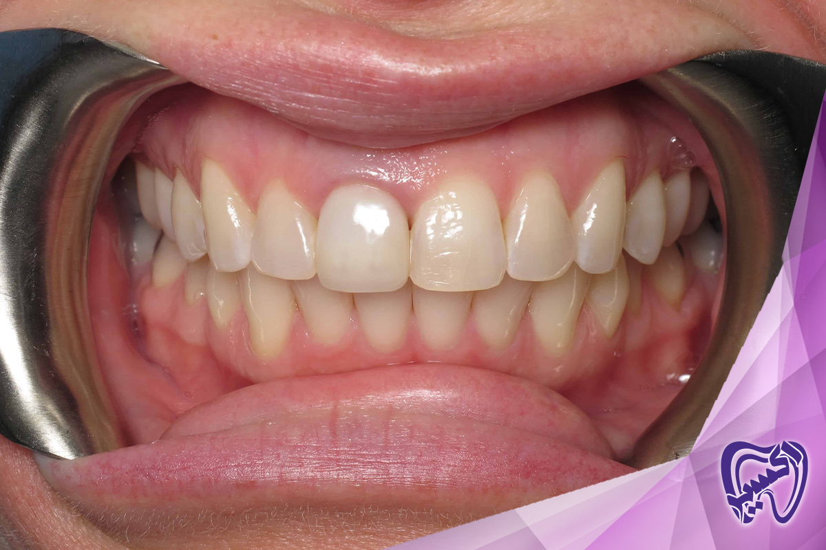 نگهداری و موفقیت در ایمپلنت دندان