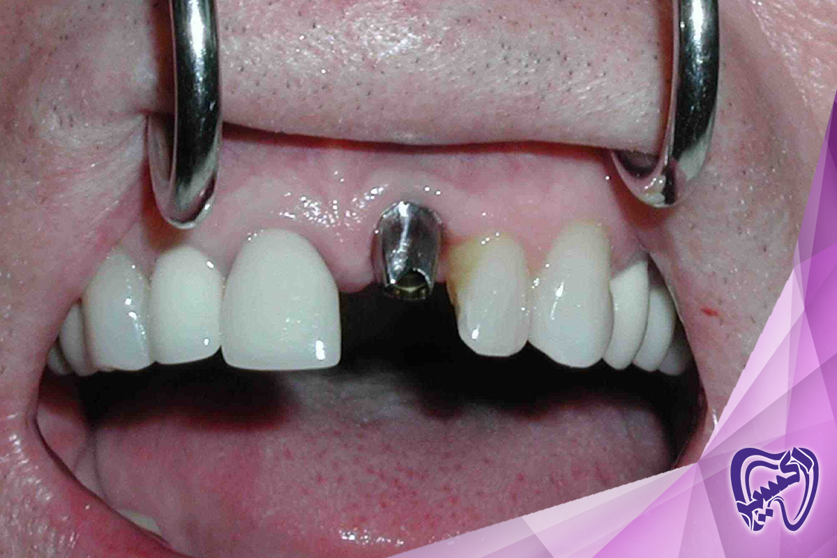 شیوه رعایت بهداشت دهان و دندان پس از ایمپلنت دندان در شهران