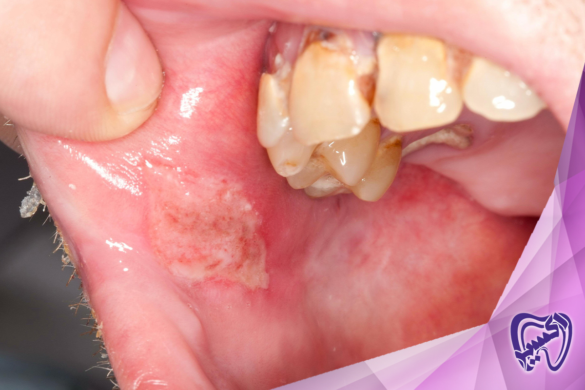 روند بهبودی بعد از جراحی دهان چقدر طول می‌کشد؟