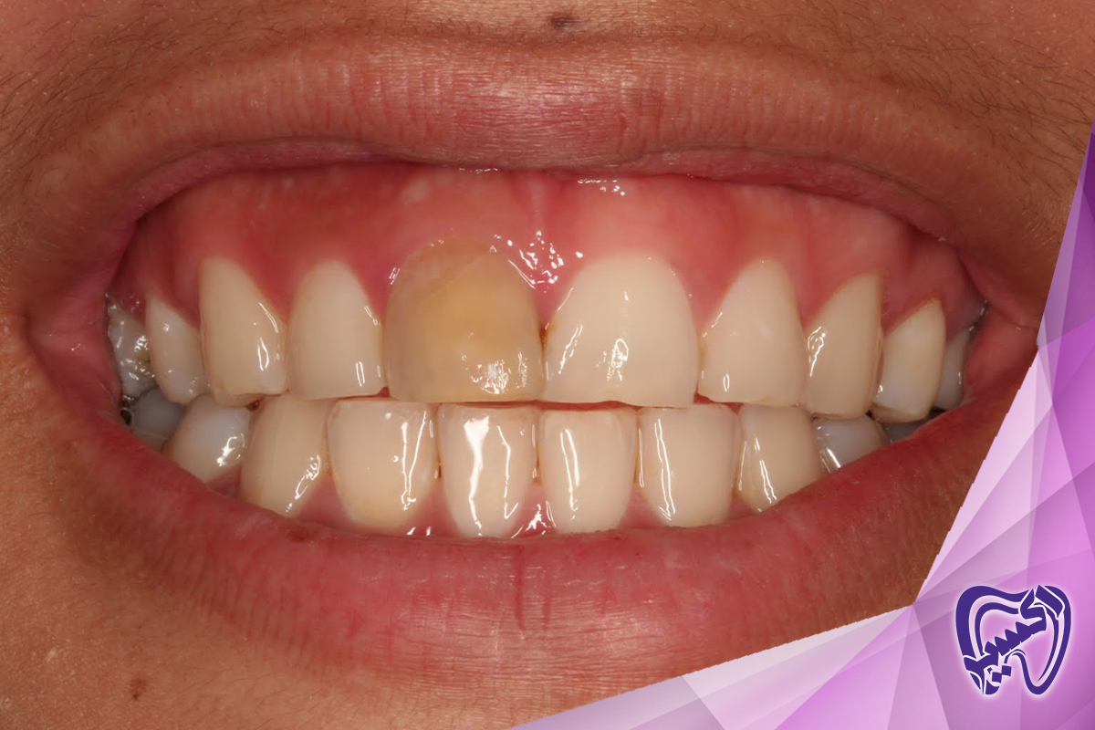 آیا بلیچینگ دندان بی خطر است؟