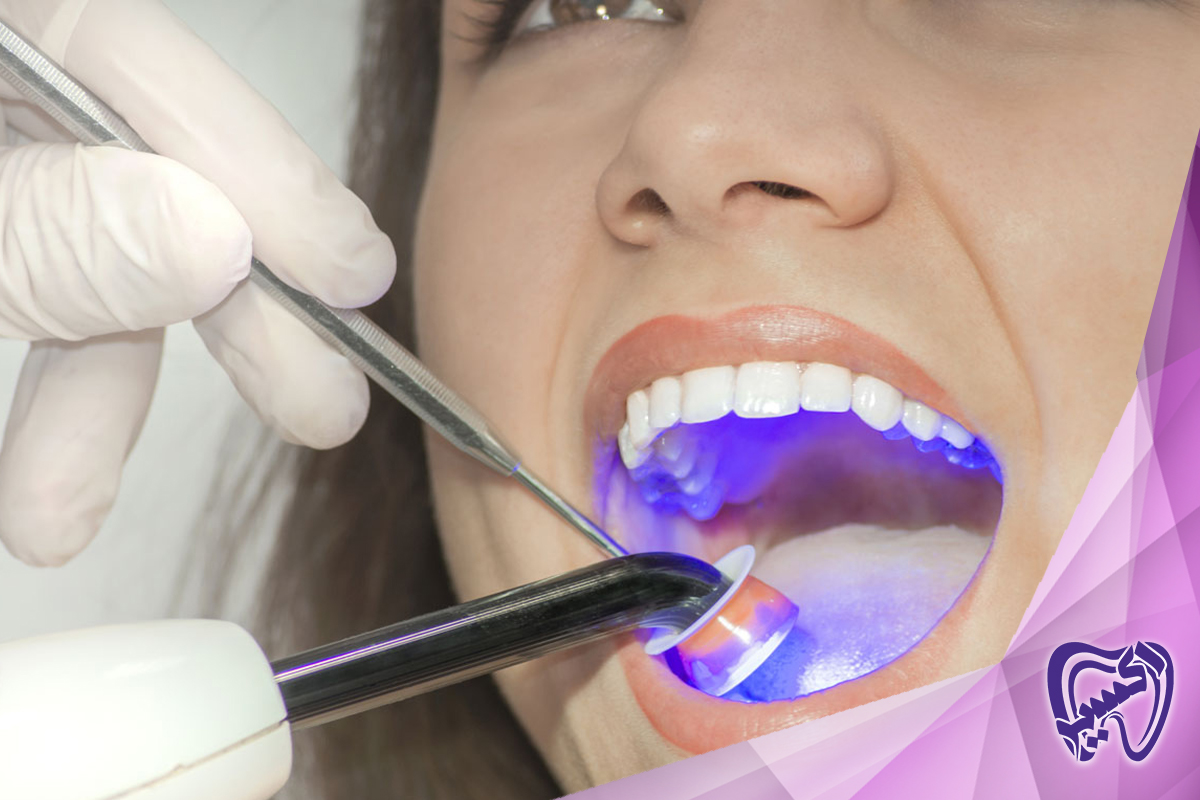 مراقبت‌های بعد از عصب کشی دندان و بهبودی
