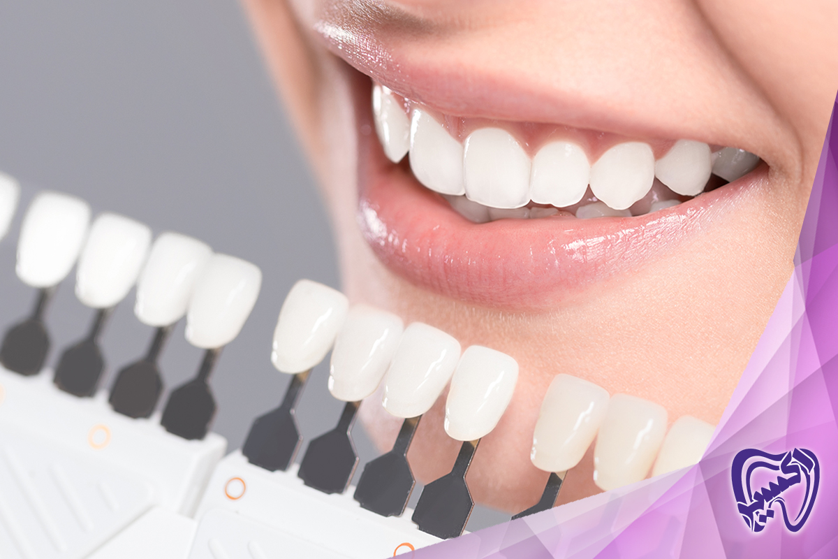دندانپزشکی اکسیر: نامی قابل اعتماد در بلیچینگ دندان شهران