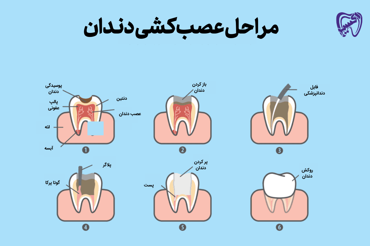 فرایند گام به گام عصب کشی دندان در شهران