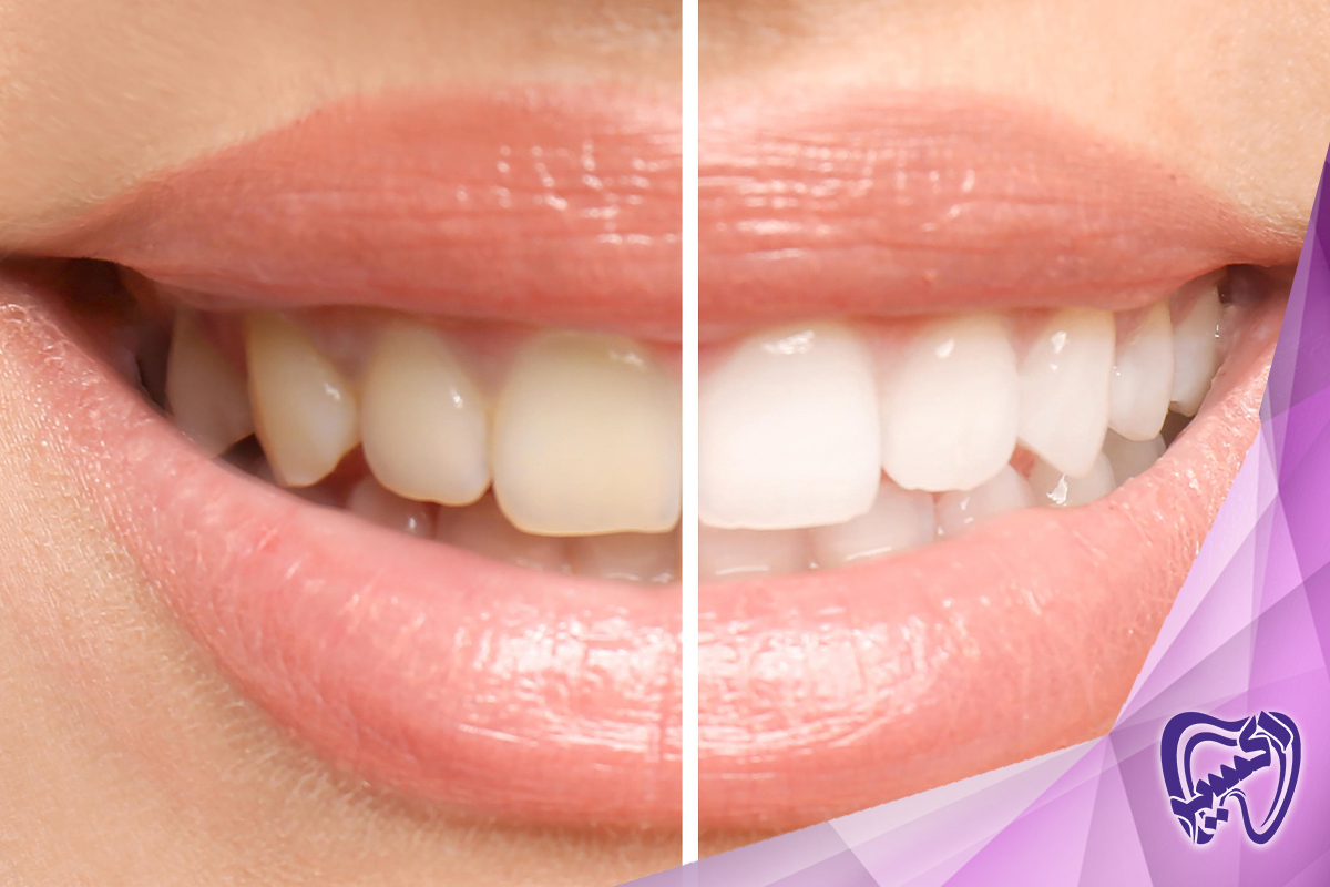 سفید کردن دندان چقدر طول می‌کشد؟