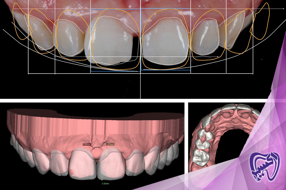 درمان فاصله بین دندانی در اصلاح طرح لبخند