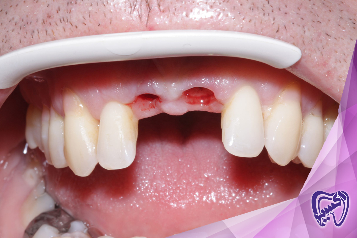 خطرات و مزایا ایمپلنت دندان