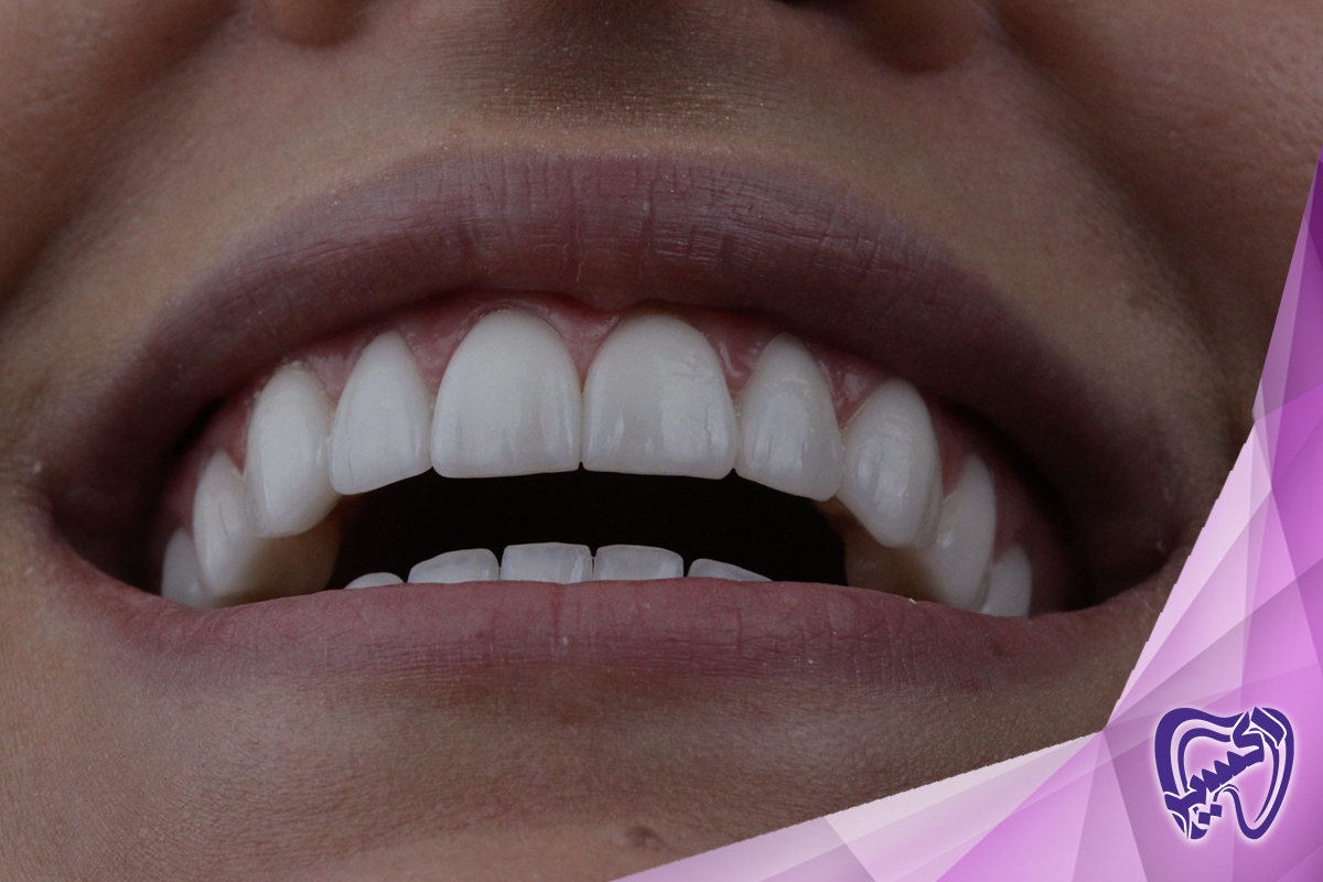 نقش دندانپزشکی اکسیر در طراحی لبخند