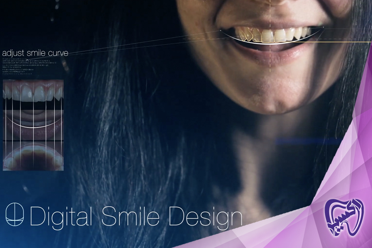 روند درمان طراحی لبخند دیجیتال