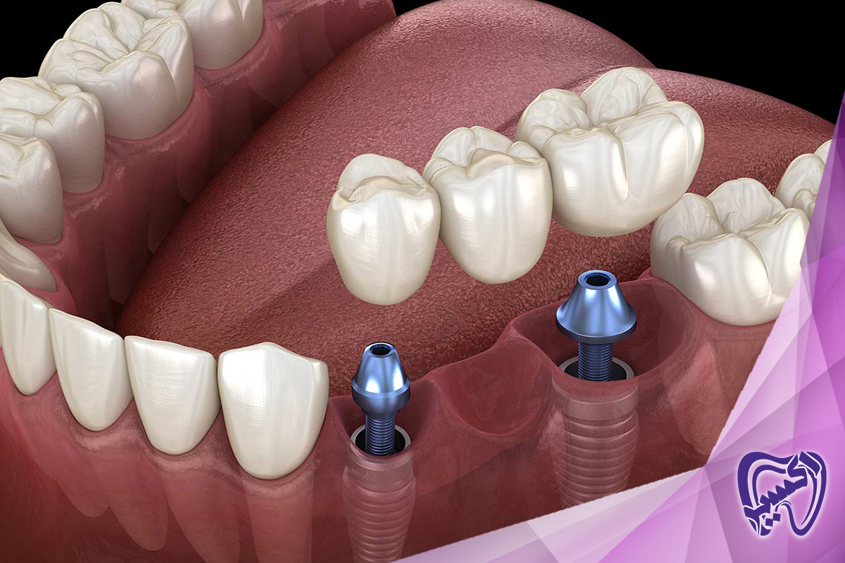 کاشت ایمپلنت دندان چگونه و در چند مرحله انجام می‌شود؟