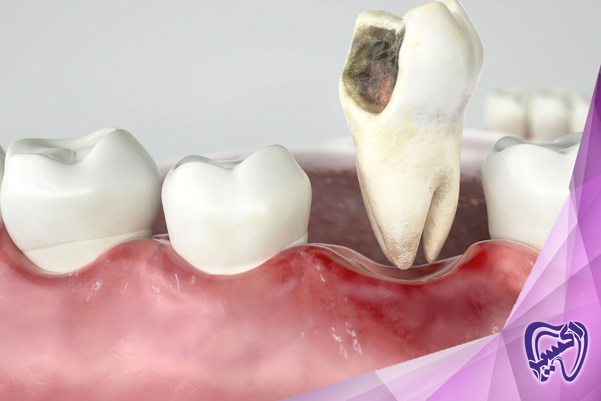 مراقبت‌های بعد از کشیدن دندان مهم هستند؟