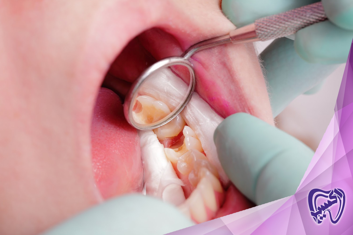 اهمیت پیشگیری از پوسیدگی دندان
