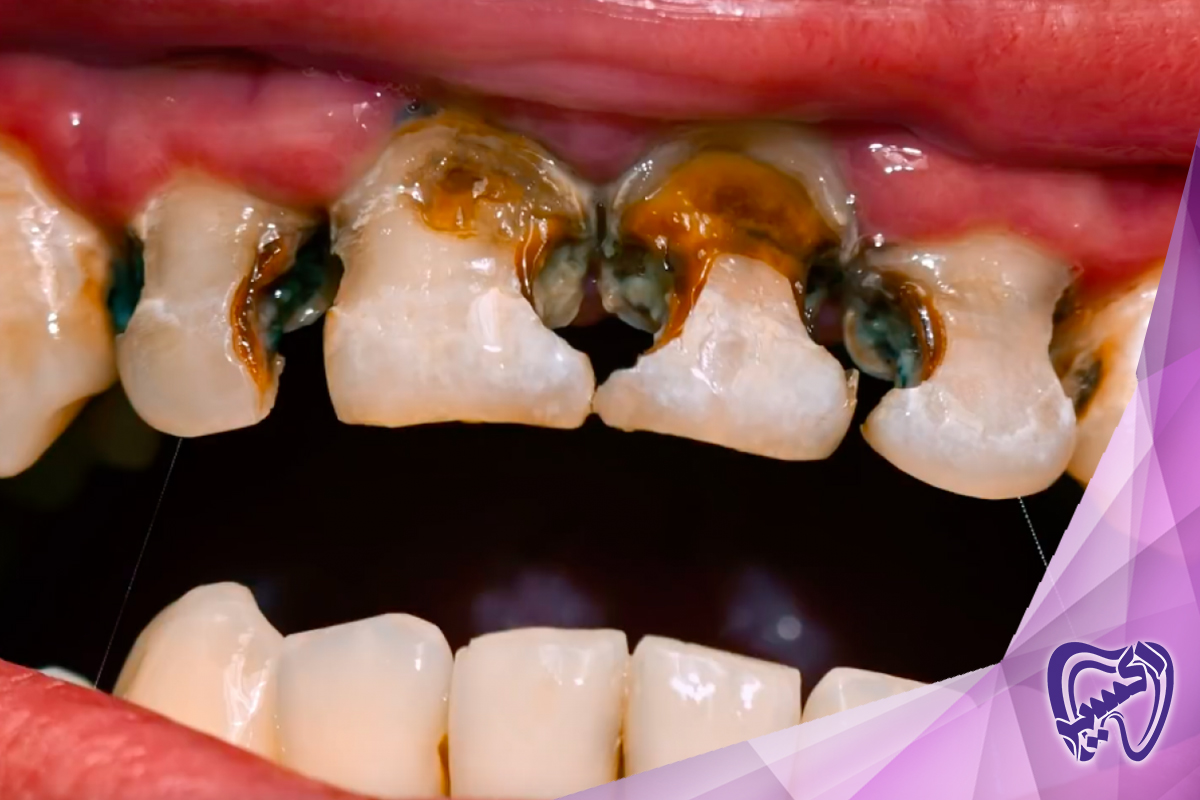 نکات کاربردی برای پیشگیری از پوسیدگی دندان