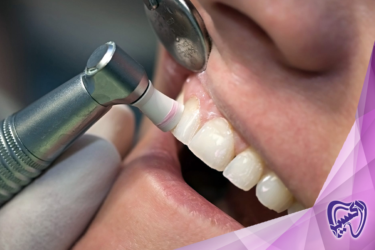 دلایل فرسایش مینای دندان چیست؟
