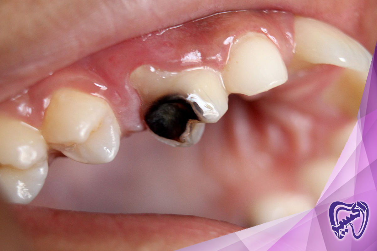 چگونه می‌توانم بفهمم که پوسیدگی دندان دارم؟