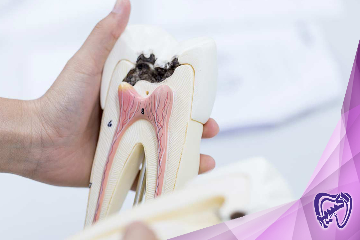 پیشگیری از پوسیدگی دندان